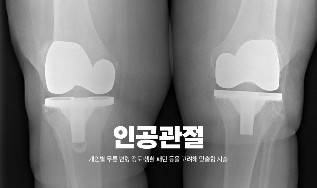 인공관절 수술