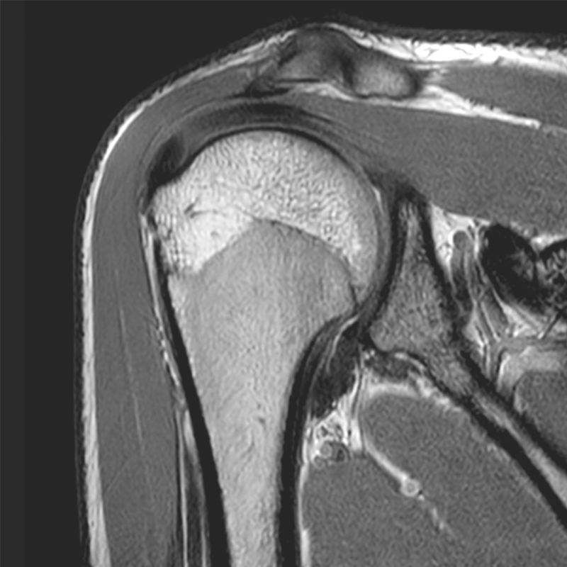 MRI