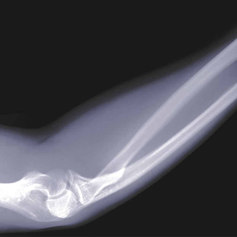 X-ray