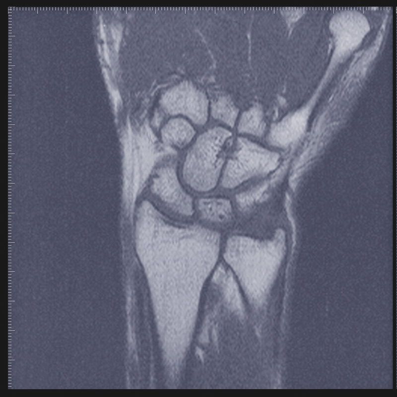 MRI